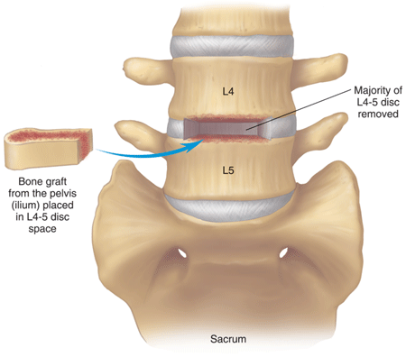 disability benefits for back pain